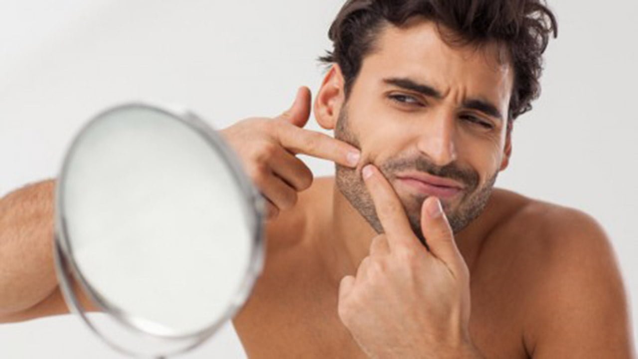 Nặn mụn đúng cách để không làm tổn thương làn da của bạn