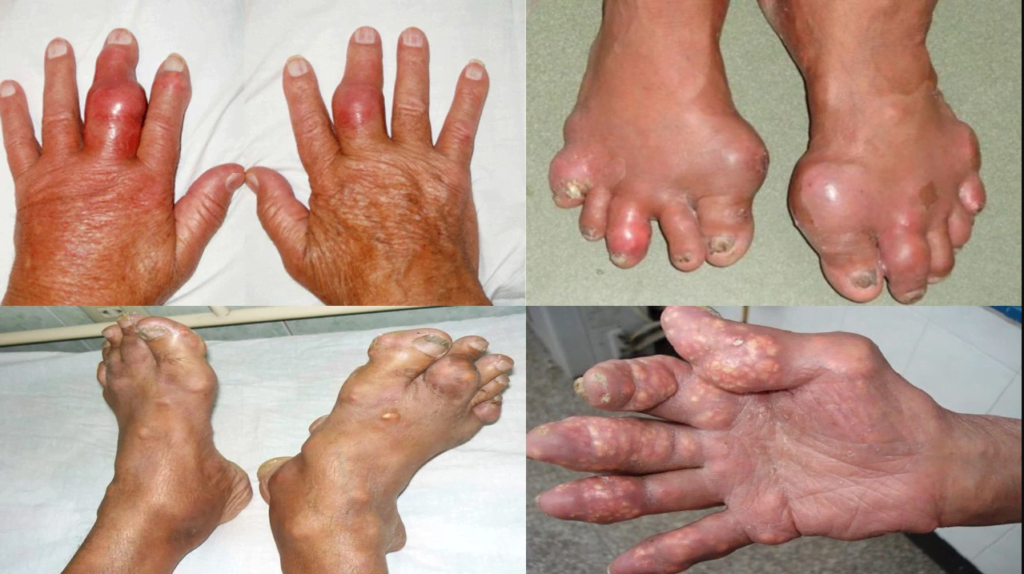 Hình ảnh về bệnh Gout giai đoạn khá nặng, các tinh thể Uric đã hình thành nhiều