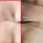 Hình ảnh Derladie Body Cleansing Bar Blemish Skin trị mụn lưng