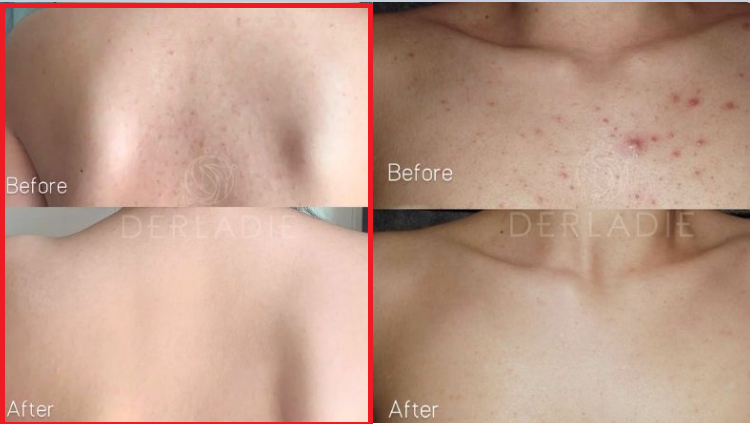 Hình ảnh Derladie Body Cleansing Bar Blemish Skin trị mụn lưng
