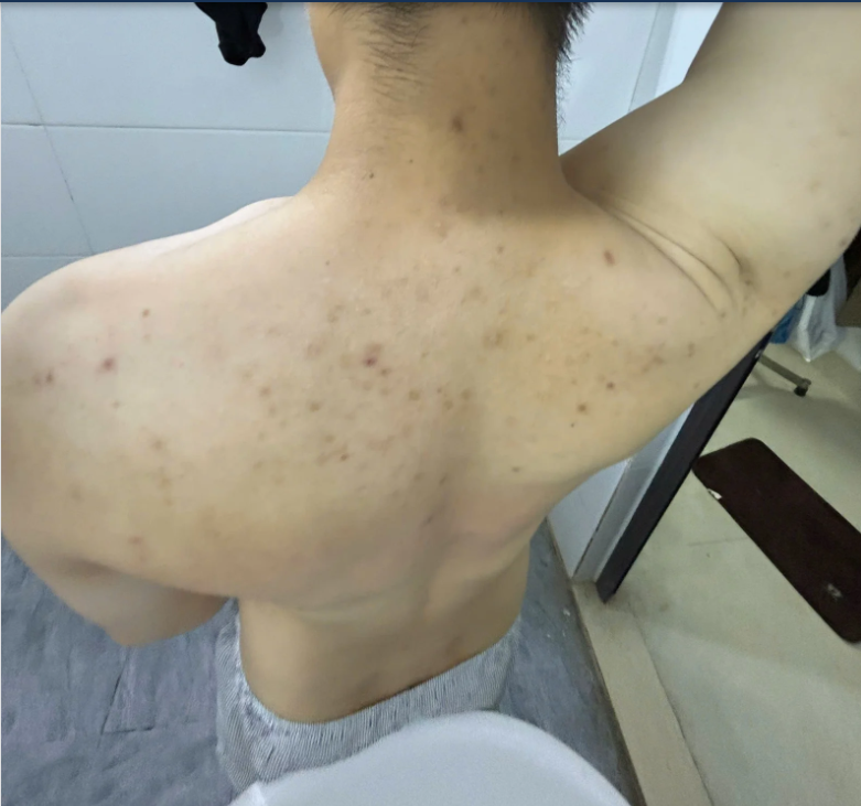 Mụn lưng là gì? nó kinh không?